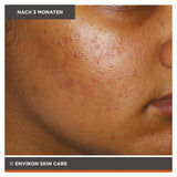 ENVIRON - Focus Care Clarity+ Botanical Infused Sebu-Spot Blemish Gel - Spezialpflege - Environ Skin Care - ZEITWUNDER Onlineshop - Kosmetik online kaufen