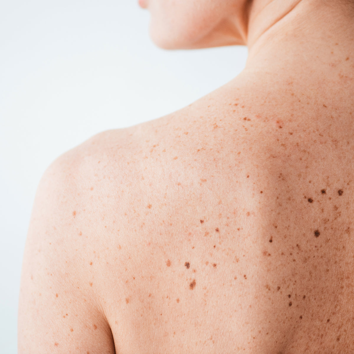 Nahaufnahme einer nackten Schulter und des oberen Rückens einer Person mit vielen sichtbaren Sommersprossen und Pigmentflecken, vor hellem, neutralem Hintergrund.